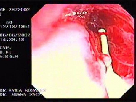 Zollinger- Ellison Syndrome - Gastric Ulcer with Gastrocolic Fistula (12 of 21)