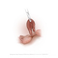Removing the Fallopian / Uterine Tube (Salpingectomy)