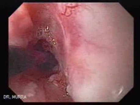 Colonic Interposition for Esophageal Substitution (2 of 11)