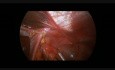 One stage laparoscopic Ladd procedure, appendectomy and Nissen fundoplication in 7-year old boy