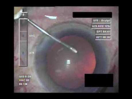 Cataract Surgery IV - Part 1