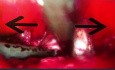 vNOTES Isolation of Anterior Vesicouterine Peritoneum