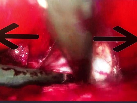 vNOTES Isolation of Anterior Vesicouterine Peritoneum