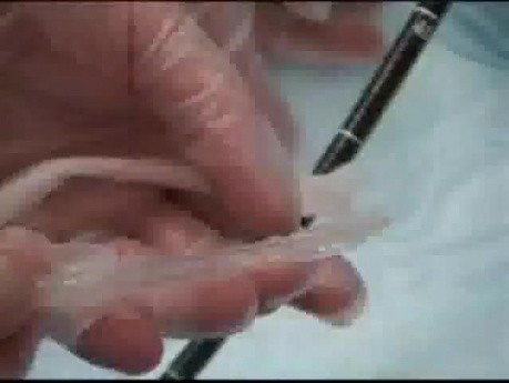 Endosocopic Intragastric Baloon Application