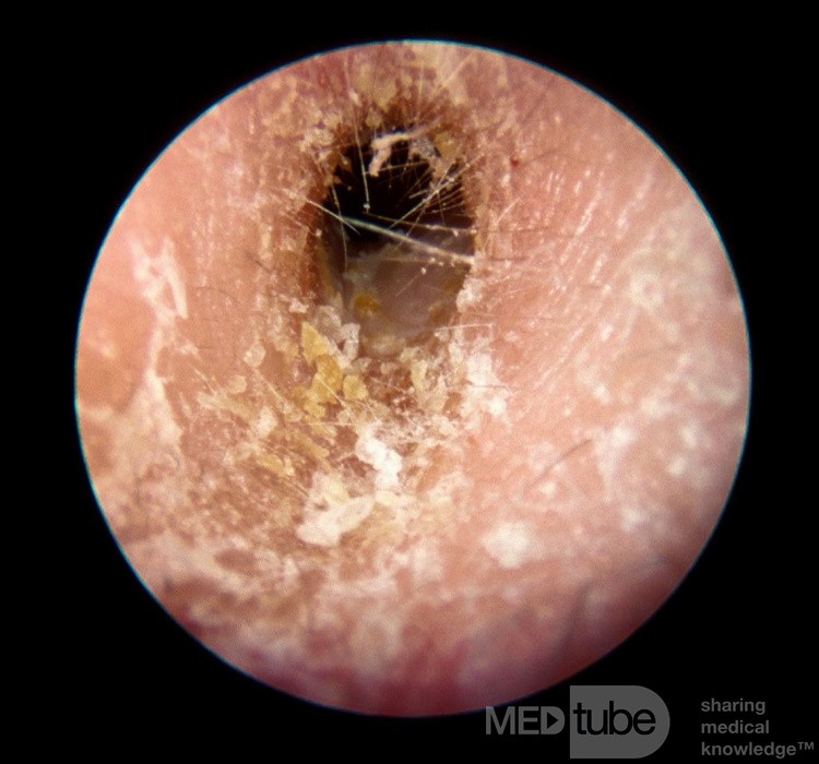 Excema External Canal