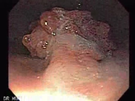 Multilobulated Gastric Polyp (2 of 20)