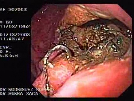 Cyst-Gastrostomy (2 of 5)