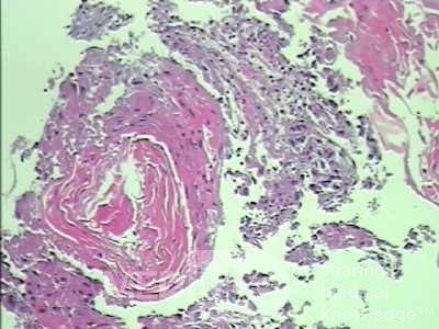 Palliation of Dysphagia of Esophageal Cancer by Endoscopic Lumen Restoration with Intraluminal tumor Debulking (16 of 18)