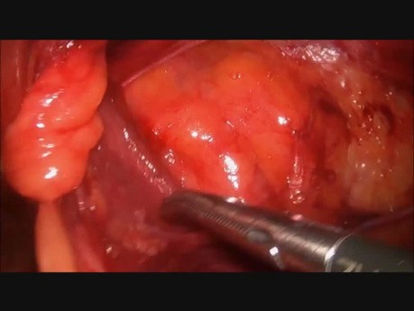 3D (Anatomical) Laparoscopic ProGrip in TAPP
