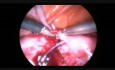 Laparoscopic Tuboplasty