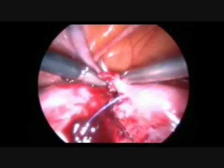 Laparoscopic Tuboplasty