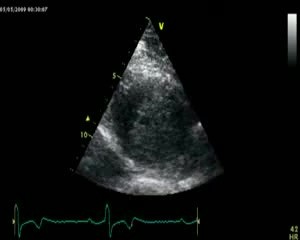 Apical Hypertrophic Cardiomyopathy
