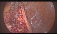 Laparoscopic Sigmoid Colectomy For Diverticulitis - Sparing IMA