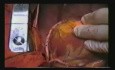 Coronary Artery Grafting With Bilateral Internal Mammary Arteries Using Composite Y-Graft Technique