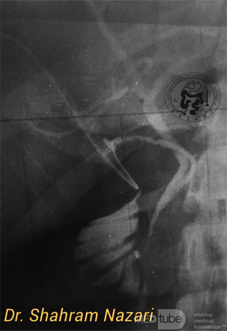 Low Junction of the Cystic Duct #3