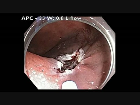 Cecum - Flat Lesion - EMR