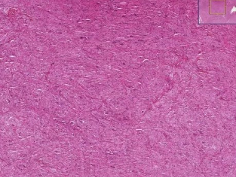Secretory endometrium