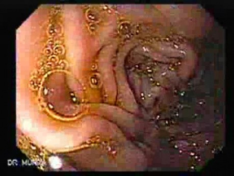 Duodenal Diverticula (2 of 2)