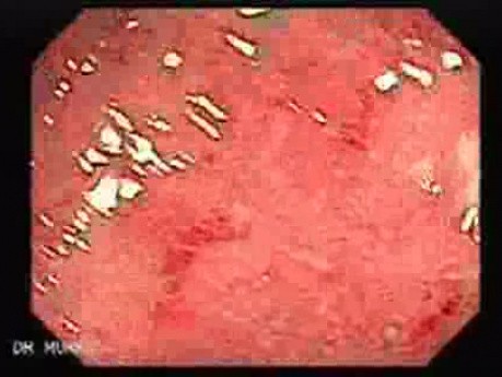 Colitis Ulcerosa - Pseudopolyps (2 of 22)