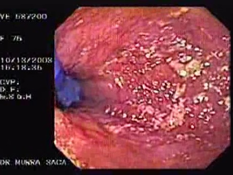 The Dilator for Achalasia Treatment to Rip the Tight LES Valve