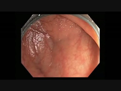 Colonoscopy Channel - Subtle Lesion in the Cecum