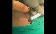 Dual-port Trans-subclavian Thyroid Endoscopic Surgery (part0)