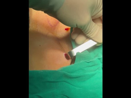 Dual-port Trans-subclavian Thyroid Endoscopic Surgery (part0)