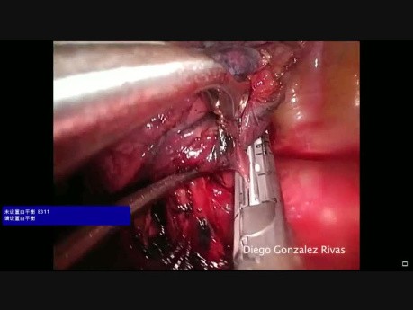 Uniportal VATS Left Basilar Segmentectomy Preserving Segment 6