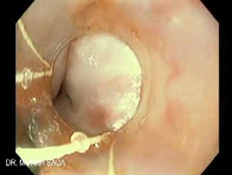 Upper GI Bleeding Due to Esophageal Varices - Banding of Varices, Part 2