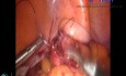 Rectal Injury During Specimen Removal by Assistant