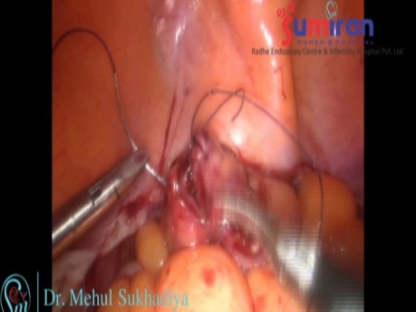 Rectal Injury During Specimen Removal by Assistant
