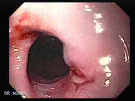 Barrett's Disease - Esophagoscopy