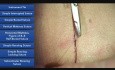Simple Interrupted Suture - Suture Techniques 