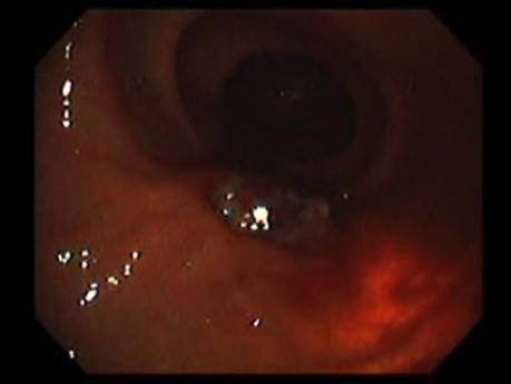 Gastrointestinal Stromal Tumor - GIST (17 of 65)