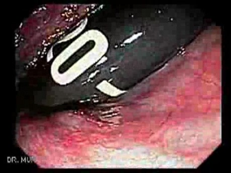 Ulcerated Internal Hemorrhoid (4 of 4)
