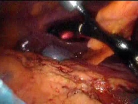 Gastrointestinal Stromal Tumor - GIST (31 of 65)