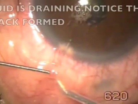 Glaucoma surgery- microtrack filtration