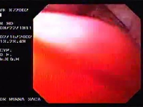 Barrett´s Esophagus (4 of 4)
