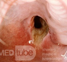 Adenocarcinoma Palate