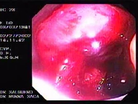 Colonoscopy - Rectum Adenocarcinoma (3 of 3)