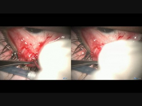 Microcorneal, Severe Ptosis, Poor Levator Function - Singh Orbital Approach