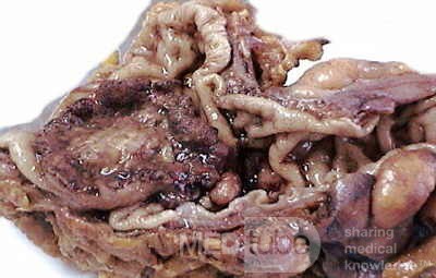 Rectal Adenocarcinoma that infiltrates the second and the 
 third valve (3 of 5)