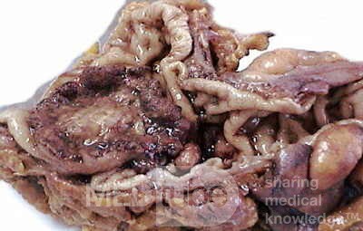 Rectal Adenocarcinoma that infiltrates the second and the 
 third valve (3 of 5)