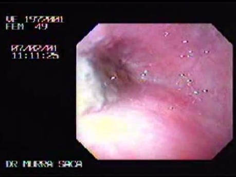 Tubulo - Villous Adenoma - Endoscopy (1 of 28)