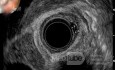EUS images of the granular cell of the distal esophagus