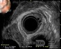 EUS images of the granular cell of the distal esophagus