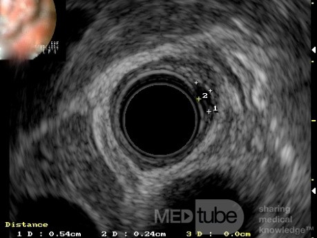 EUS images of the granular cell of the distal esophagus