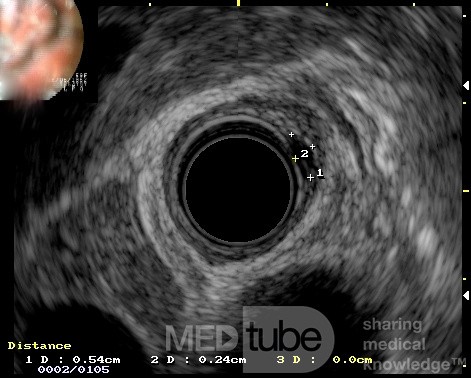 EUS images of the granular cell of the distal esophagus