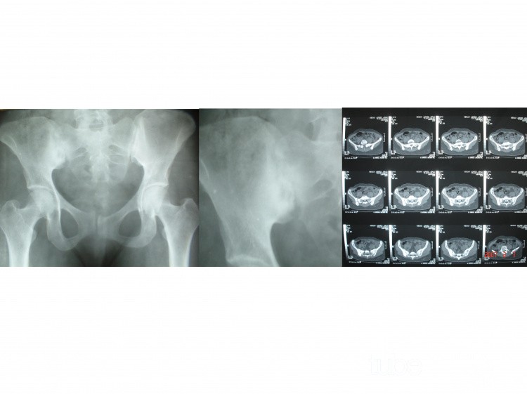 TB Artheritis of Rt. sacroiliac joint