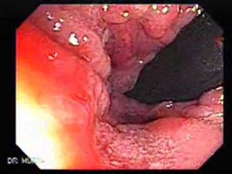 Multiple Adenomatous Polyps Of The Rectum (17 of 37)